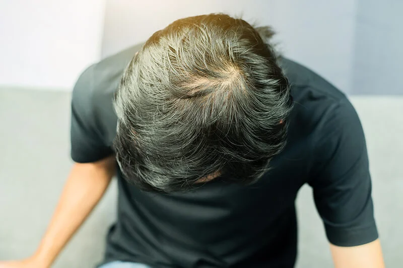 Fünf Mythen über Haarausfall – was wirklich stimmt