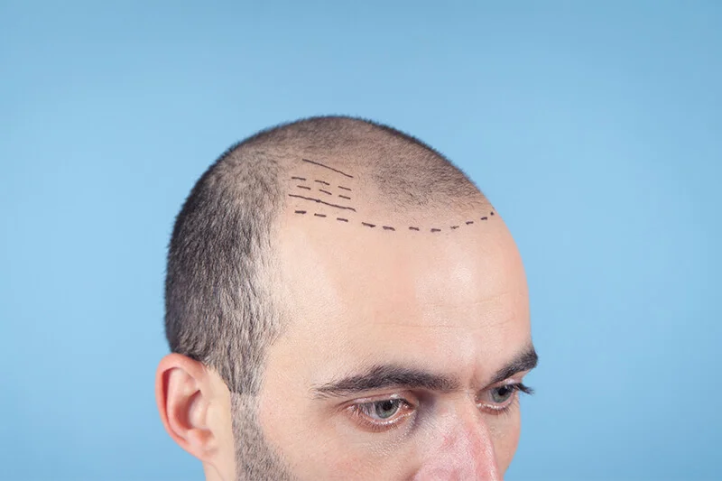 Haartransplantation: Das Design des perfekten Haaransatzes