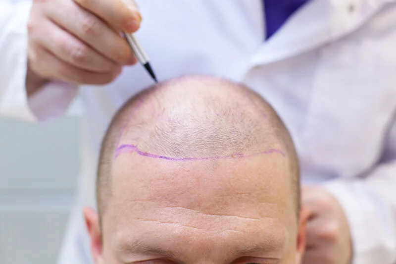 Haartransplantation in der Türkei: Gründe, Ablauf und Vorteile