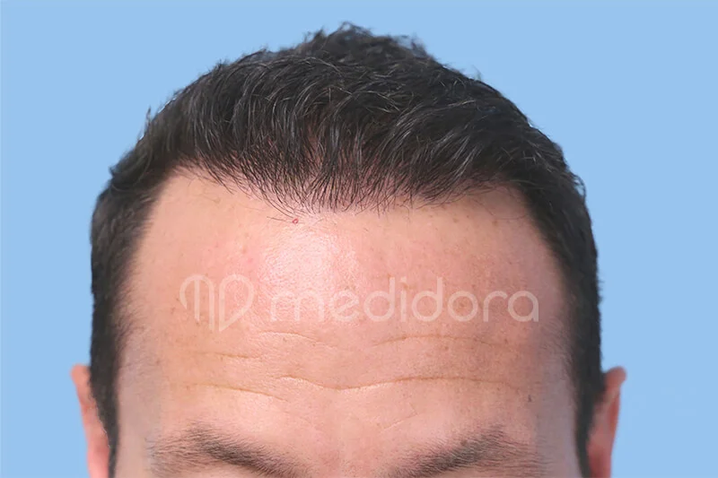 Haartransplantation Vorher Nachher