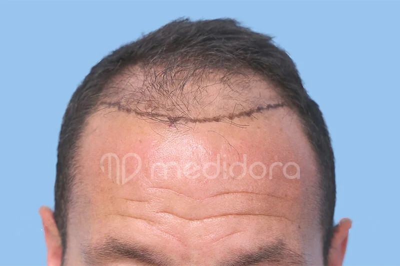 Haartransplantation Vorher Nachher