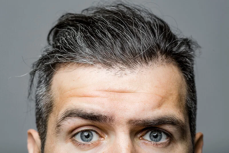 Haartransplantation – wann ist sie wirklich sinnvoll?