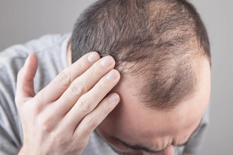 Schockhaarausfall nach einer Haartransplantation