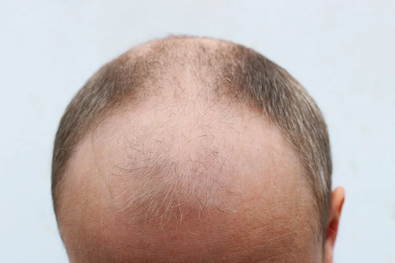 Was ist das beste Alter für eine Haartransplantation?