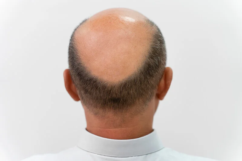 Haarausfall bekämpfen – was wirklich hilft